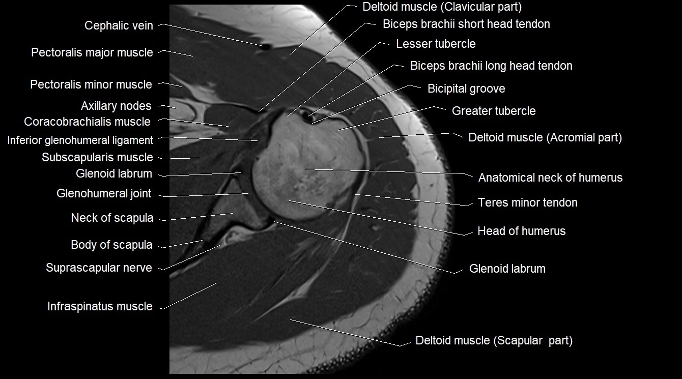 Upper arm( humerus) cross section anatomy MRI 3T axial image 12.webp